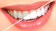 teeth-whitening Teeth Whitening - Farmington Hills