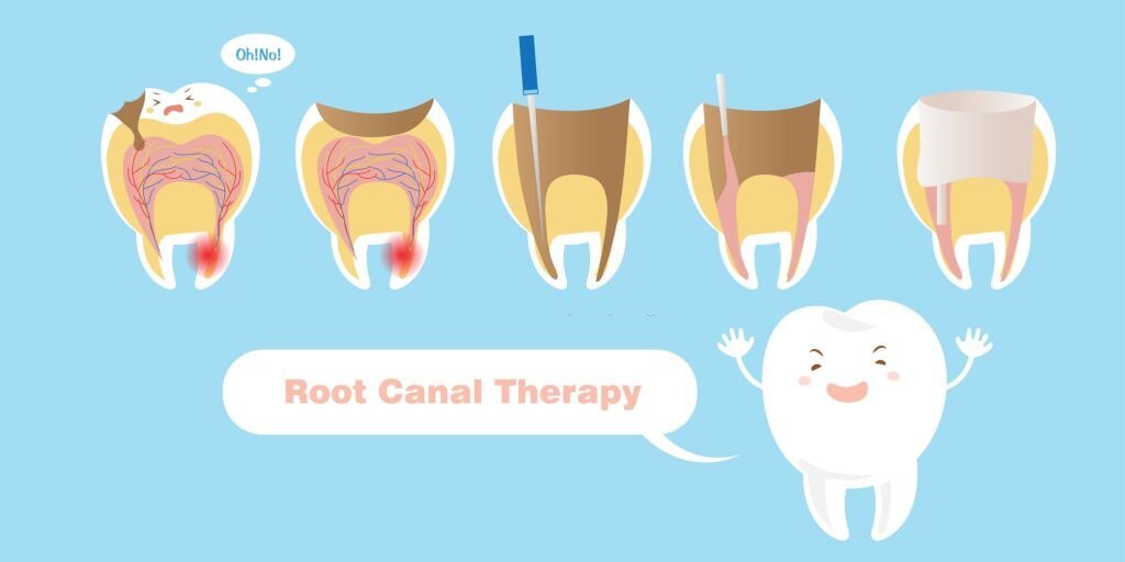 Stages Root Canal Treatment