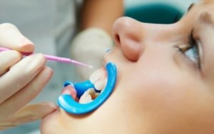 Dental Sealants Farmington Hills