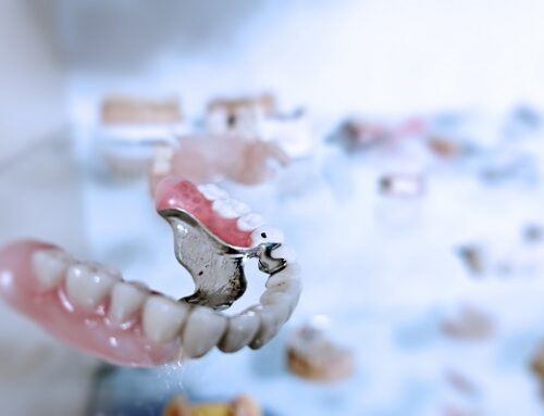 How Long Do Dental Veneers Last?