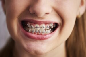 Dental Braces Farmington Hills