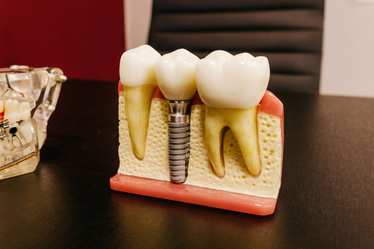 Dental Crown vs Implant Which Option is Right for You?